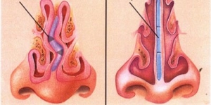 Correzione chirurgica del setto nasale deviato