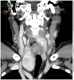 TC del collo: grosso struma multinodulare della tiroide con iniziale sviluppo endotoracico e dislocazione tracheale